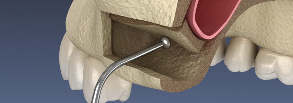 History of Sinus Lifts and Bone Grafts in Dentistry