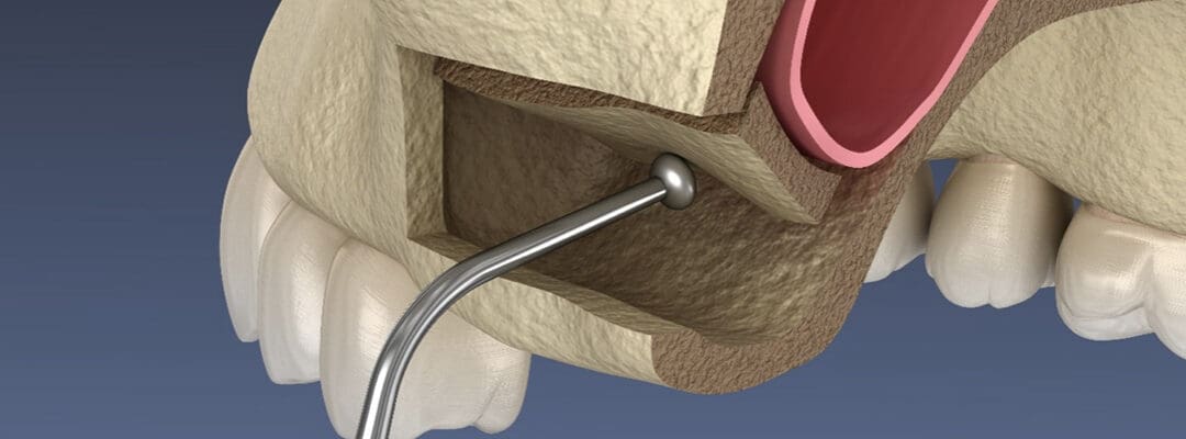 History of Sinus Lifts and Bone Grafts in Dentistry