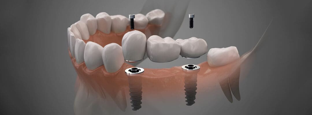 Digital Dentistry: Guided Implant Placement