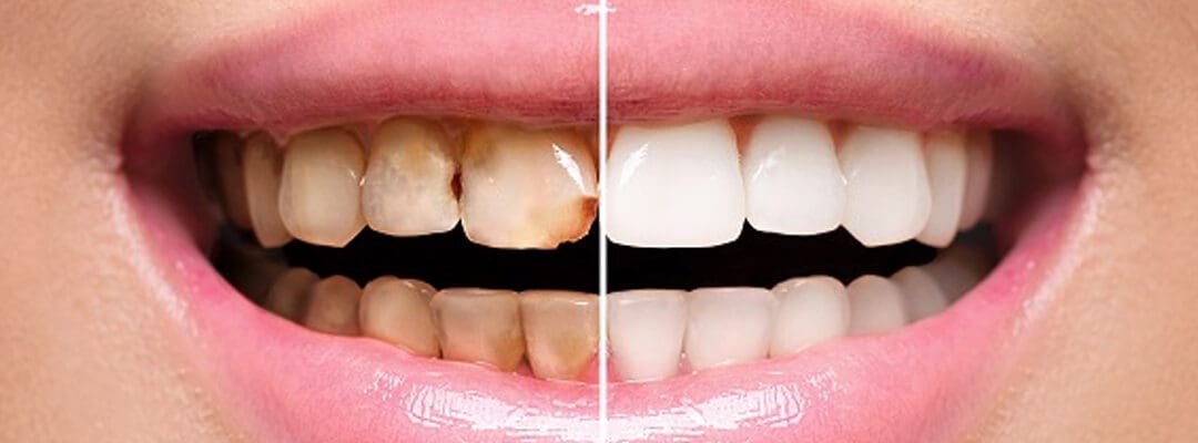 Smile Makeovers Without Bone Grafts: Aesthetic Transformations