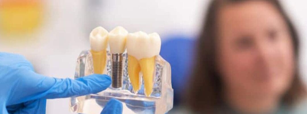 The Science Behind Basal Implants: Why They Succeed