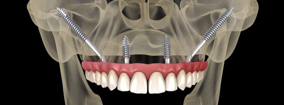 Zygomatic Implants: Anchoring to the Cheekbone