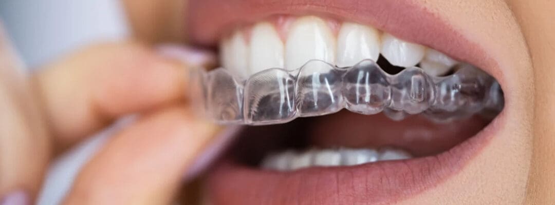 Invisalign & Beyond: Transforming Smiles with Orthodontics