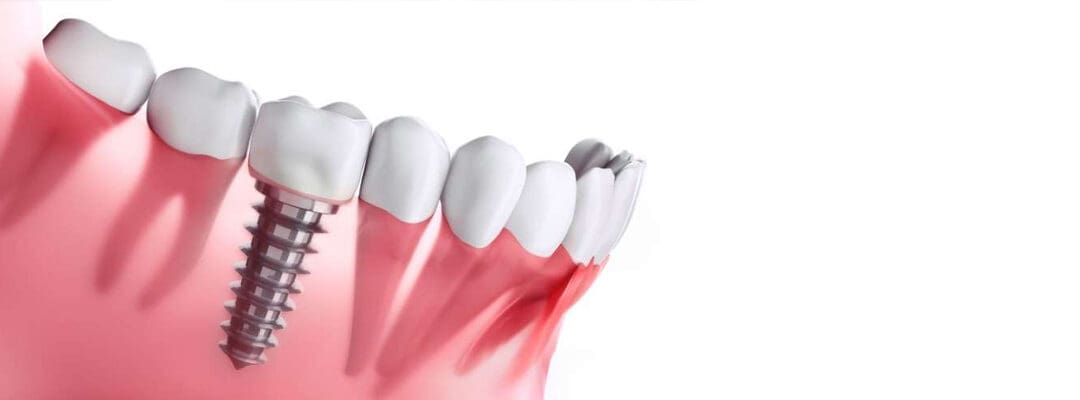 The Evolution of Dental Implants: A Journey Through Time