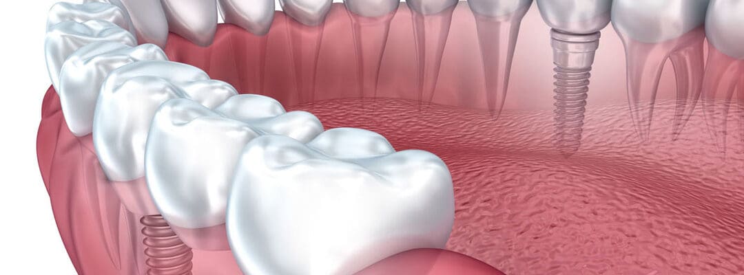Reclaim Your Smile: Basal Implants with Zirconia Crowns
