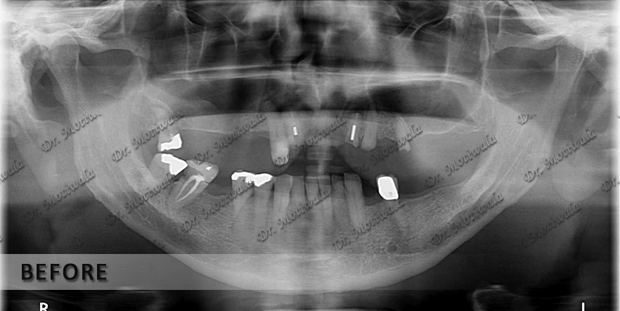 case6a