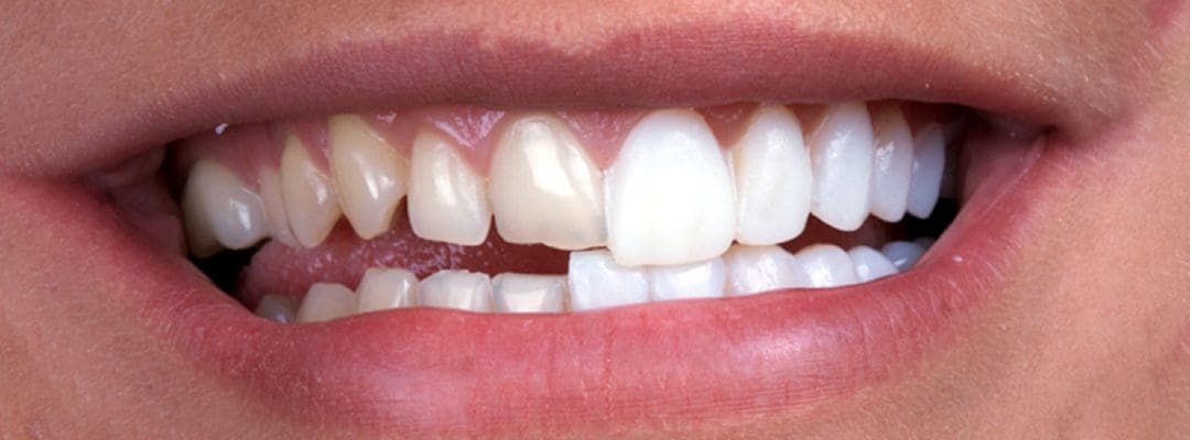 How to Spot a Bad Smile Makeover: Red Flags to Watch Out For