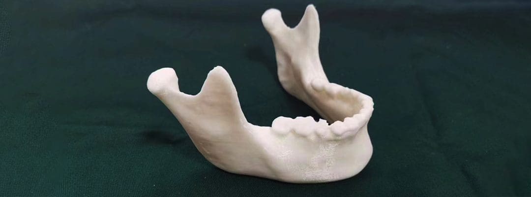 3D-Printed Jawlines: How Custom Implants Eliminate Grafting Needs