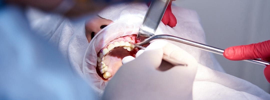 Sinus Lift: Why Some Dentists Still Push This Outdated Procedure